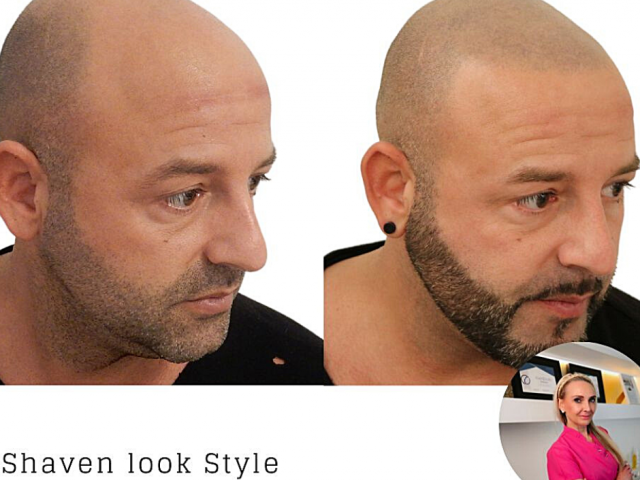 Reversing Baldness with Hair Pigmentation - Prohair Clinic