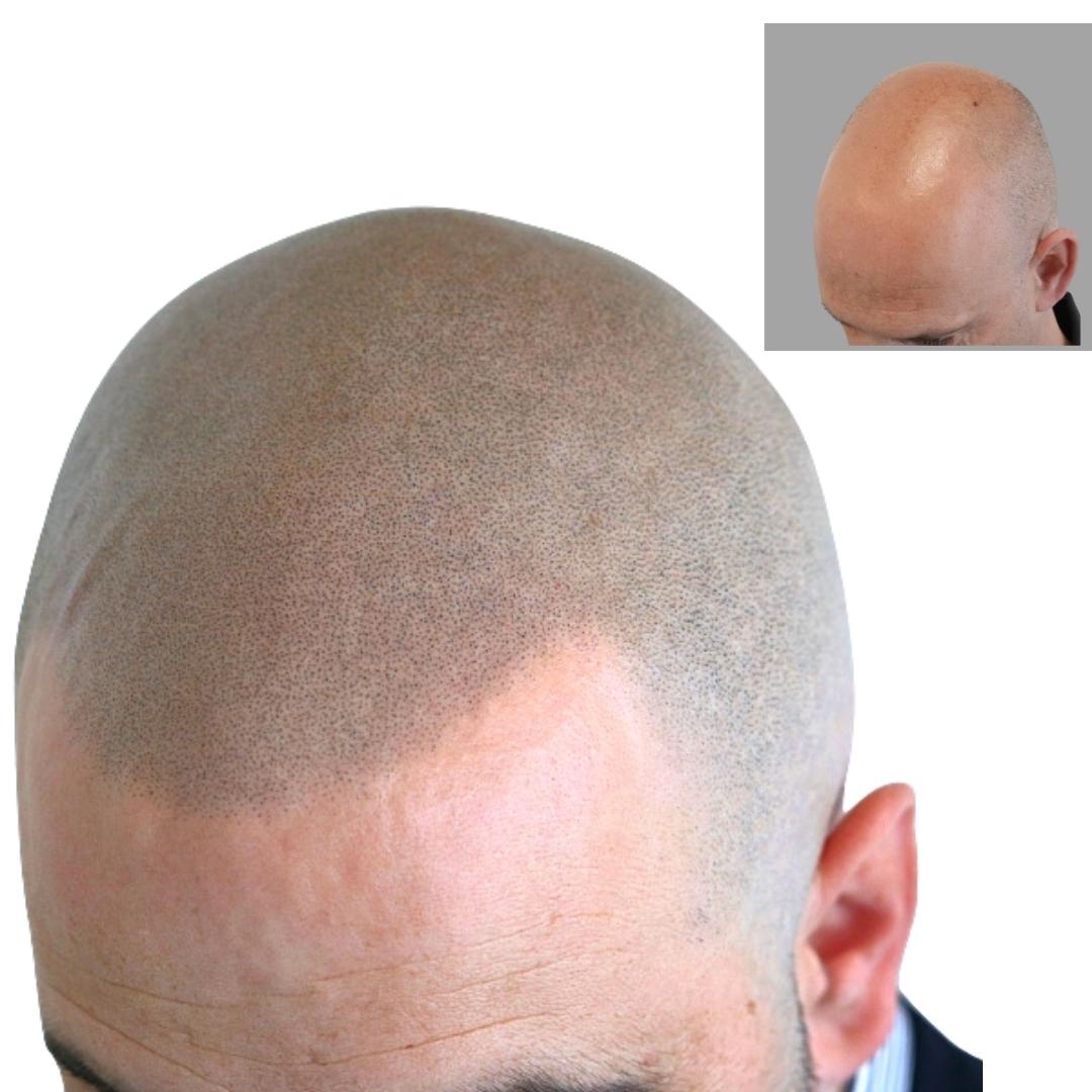 This man was bald until 30 days ago