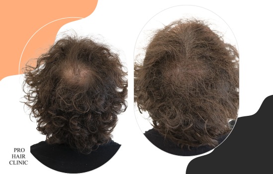 Densification of crown area after hair transplantation