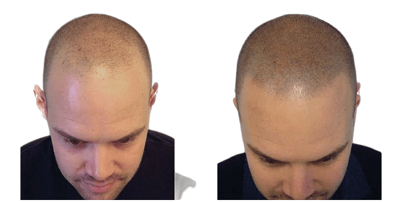 Using hair pigmentation to enhance optical hair density - Prohair Clinic