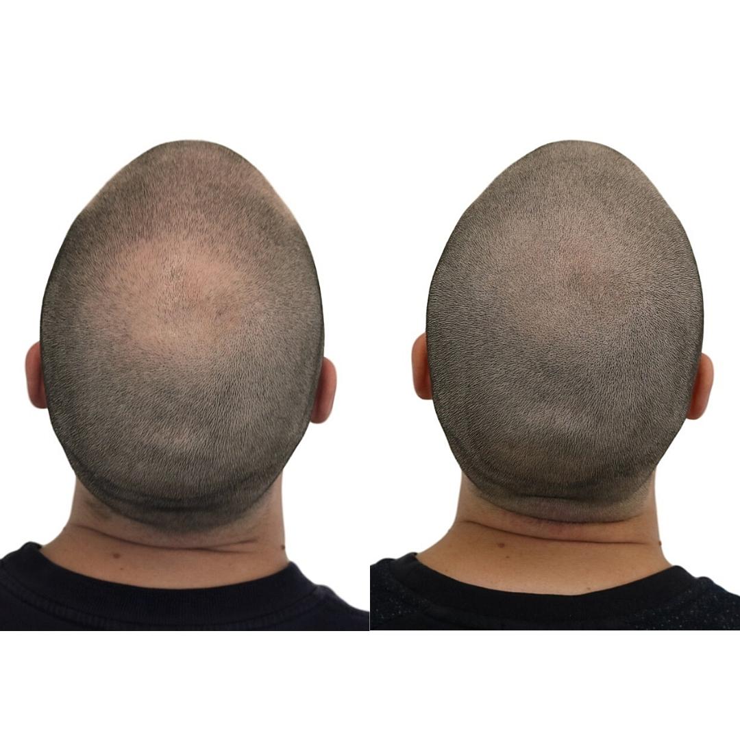 Hair loss or bald? Hair pigmentation SMP is the answer - Prohair Clinic