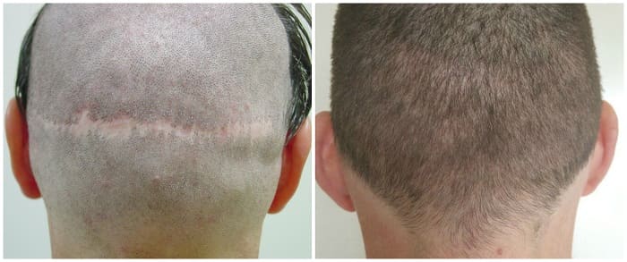 Benefits FUE hair restoration - Prohair Clinic