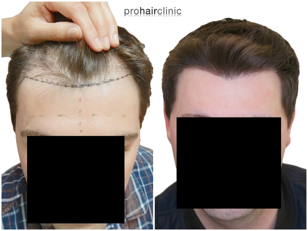 FUE dense packing - Prohair Clinic