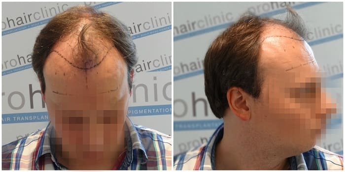 Regrowth phase after a hair transplantation - Prohair Clinic