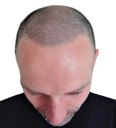 Aggregate 76+ hair transplant after 20 days - in.eteachers